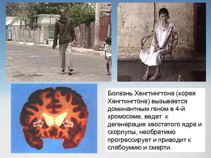 Болезнь Хенгтингтона (хорея Хенгтингтона) вызывается доминантным геном в 4 -й хромосоме, ведет к дегенерация