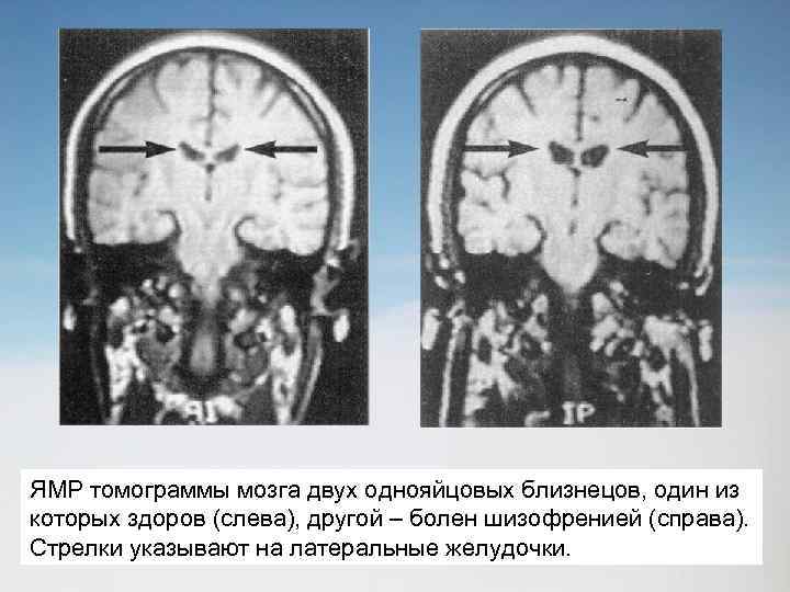 ЯМР томограммы мозга двух однояйцовых близнецов, один из которых здоров (слева), другой – болен