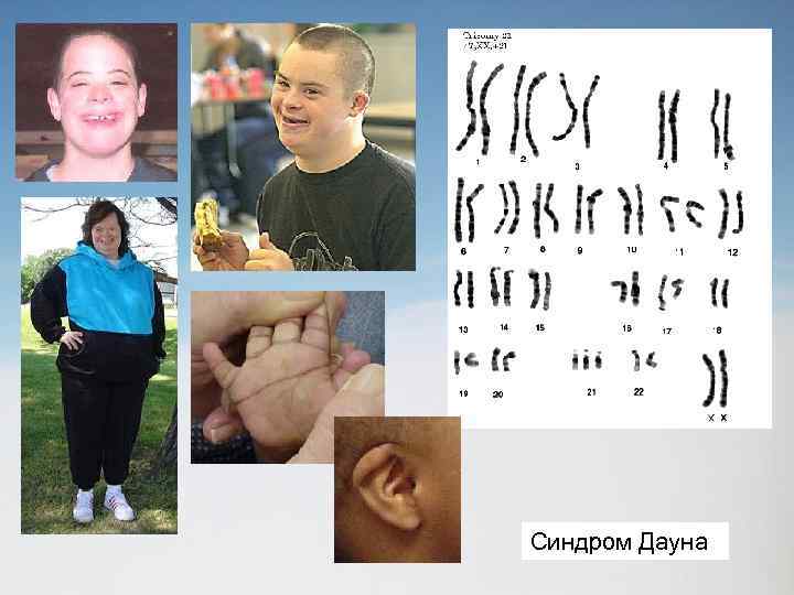 Синдром Дауна 