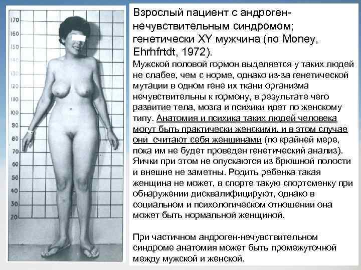 Взрослый пациент с андрогеннечувствительным синдромом; генетически XY мужчина (по Money, Ehrhfrtdt, 1972). Мужской половой