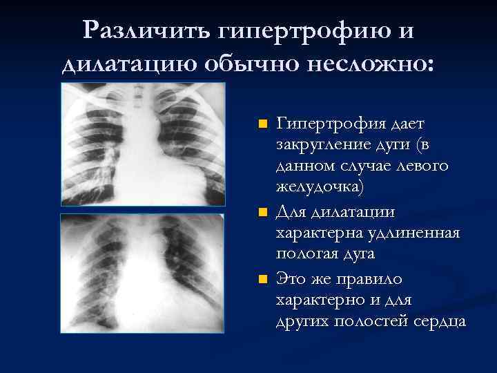 Различить гипертрофию и дилатацию обычно несложно: n n n Гипертрофия дает закругление дуги (в