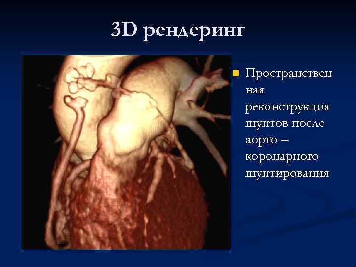 3 D рендеринг n Пространствен ная реконструкция шунтов после аорто – коронарного шунтирования 