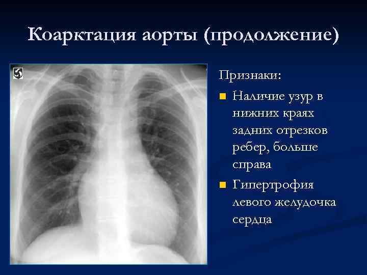 Коарктация аорты (продолжение) Признаки: n Наличие узур в нижних краях задних отрезков ребер, больше
