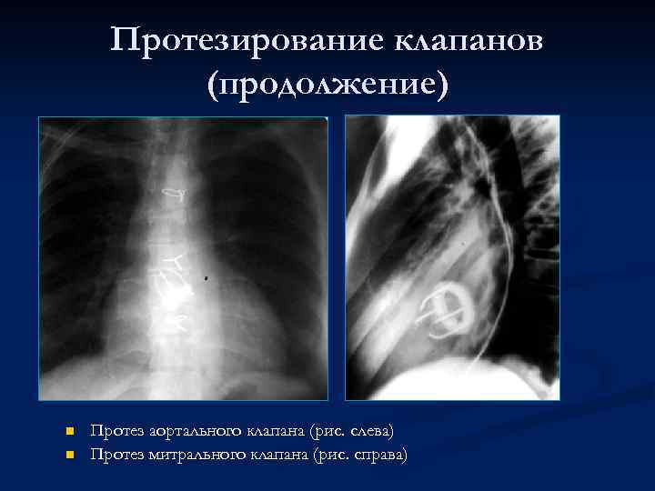 Протезирование клапанов (продолжение) n n Протез аортального клапана (рис. слева) Протез митрального клапана (рис.