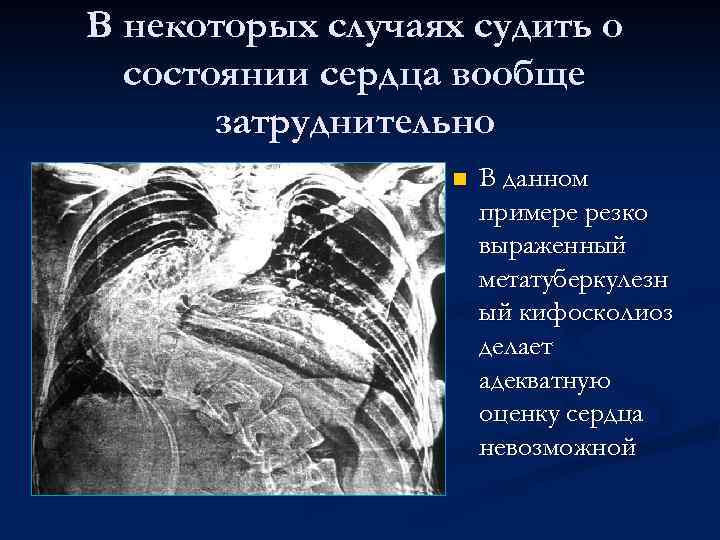 В некоторых случаях судить о состоянии сердца вообще затруднительно n В данном примере резко