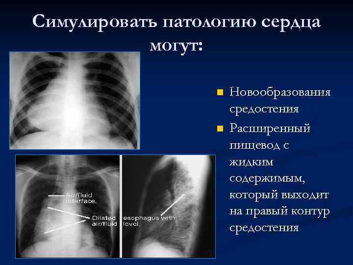 Симулировать патологию сердца могут: n n Новообразования средостения Расширенный пищевод с жидким содержимым, который
