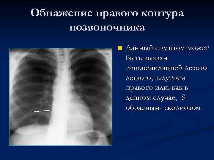 Обнажение правого контура позвоночника n Данный симптом может быть вызван гиповениляцией левого легкого, вздутием