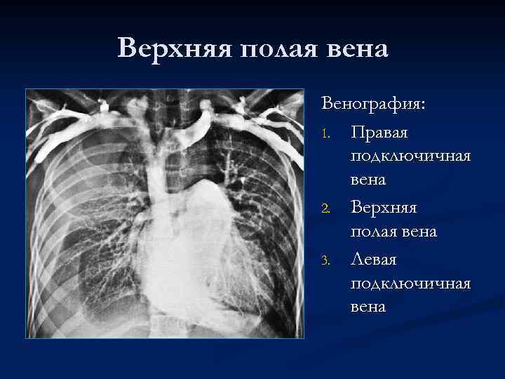 Верхняя полая вена Венография: 1. Правая подключичная вена 2. Верхняя полая вена 3. Левая