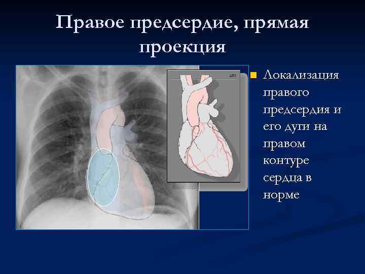 Правое предсердие, прямая проекция n Локализация правого предсердия и его дуги на правом контуре
