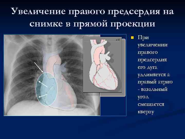 Увеличение правого предсердия на снимке в прямой проекции n При увеличении правого предсердия его