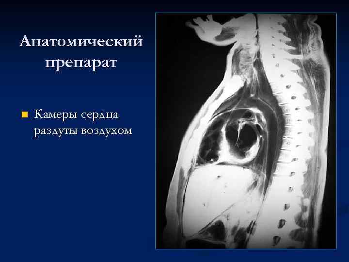 Анатомический препарат n Камеры сердца раздуты воздухом 