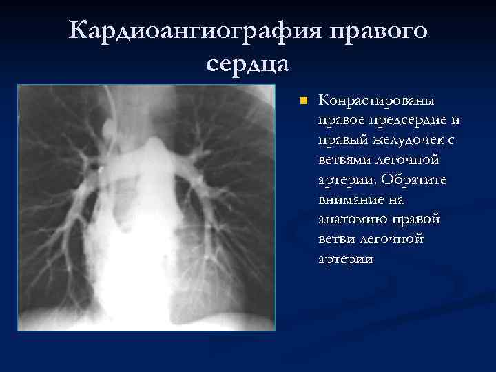 Кардиоангиография правого сердца n Конрастированы правое предсердие и правый желудочек с ветвями легочной артерии.