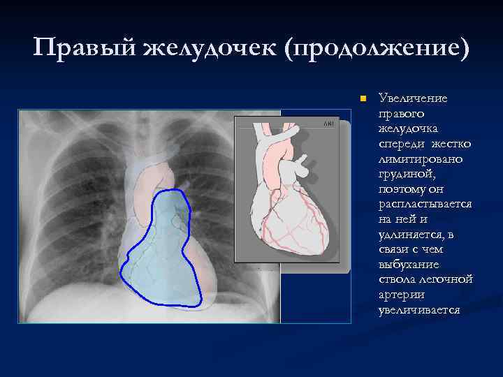Правый желудочек (продолжение) n Увеличение правого желудочка спереди жестко лимитировано грудиной, поэтому он распластывается