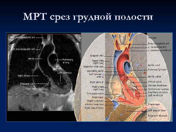 МРТ срез грудной полости 
