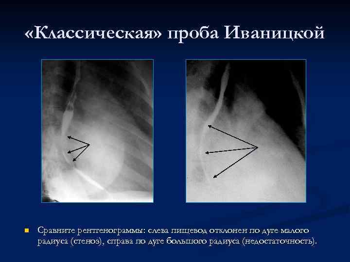  «Классическая» проба Иваницкой n Сравните рентгенограммы: слева пищевод отклонен по дуге малого радиуса