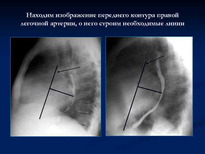 Находим изображение переднего контура правой легочной артерии, о него строим необходимые линии 