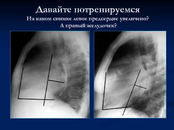 Давайте потренируемся На каком снимке левое предсердие увеличено? А правый желудочек? 