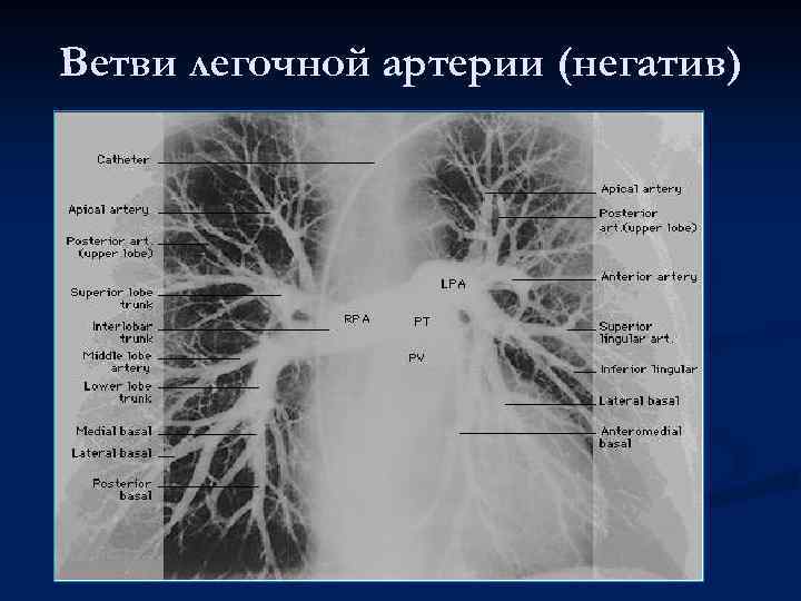 Ветви легочной артерии (негатив) 