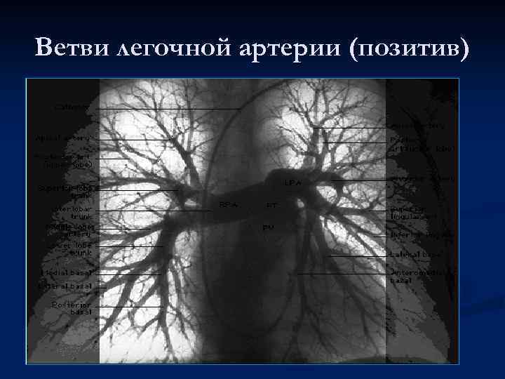 Ветви легочной артерии (позитив) 