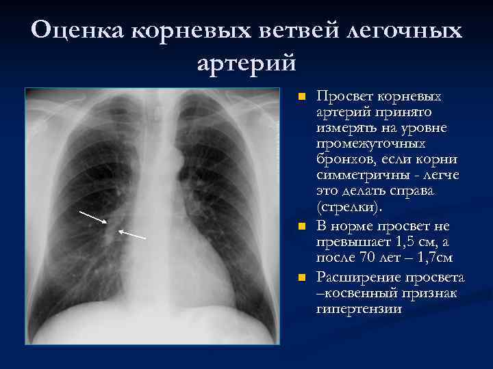 Оценка корневых ветвей легочных артерий n n n Просвет корневых артерий принято измерять на