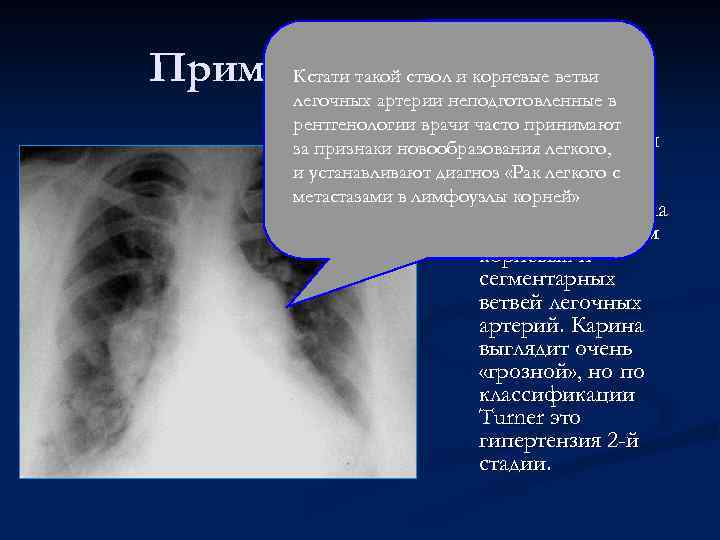 Пример гипертензии Кстати такой ствол и корневые ветви легочных артерии неподготовленные в рентгенологии врачи