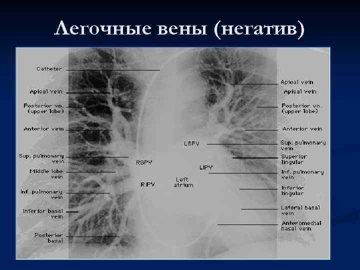 Легочные вены (негатив) 