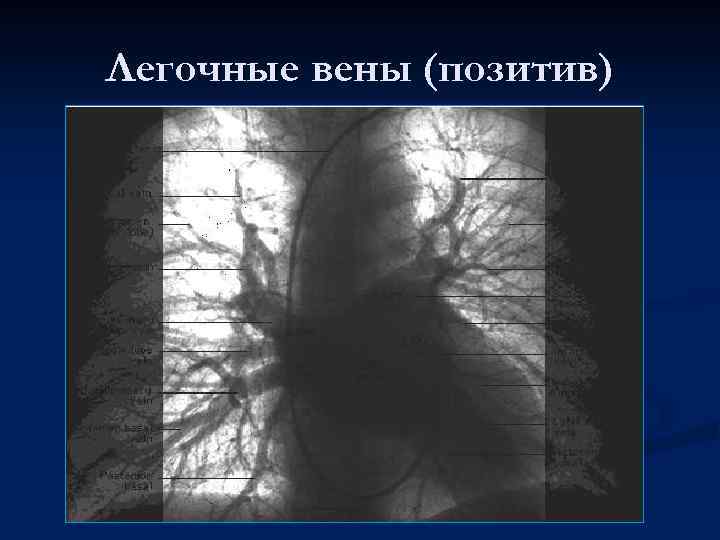 Легочные вены (позитив) 
