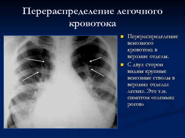 Перераспределение легочного кровотока n n Перераспределение венозного кровотока в верхние отделы. С двух сторон