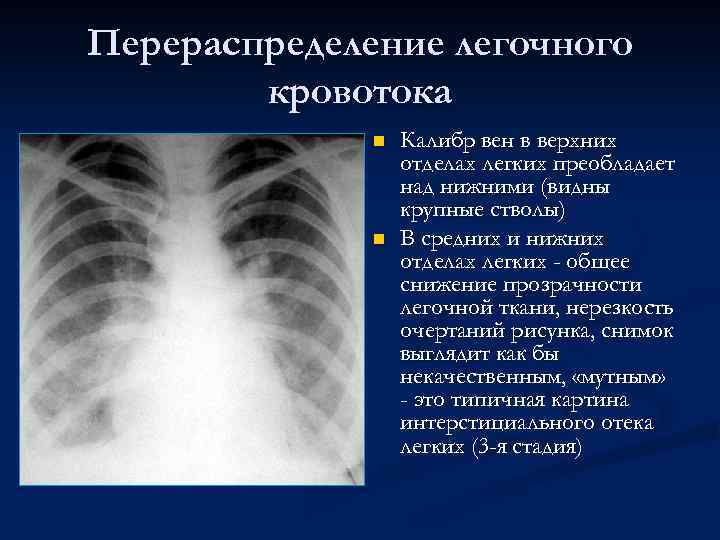 Перераспределение легочного кровотока n n Калибр вен в верхних отделах легких преобладает над нижними