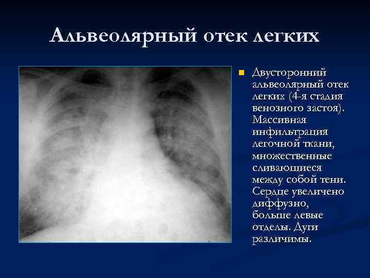 Альвеолярный отек легких n Двусторонний альвеолярный отек легких (4 -я стадия венозного застоя). Массивная