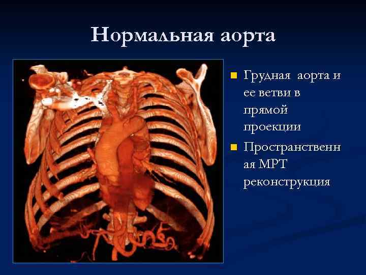 Нормальная аорта n n Грудная аорта и ее ветви в прямой проекции Пространственн ая