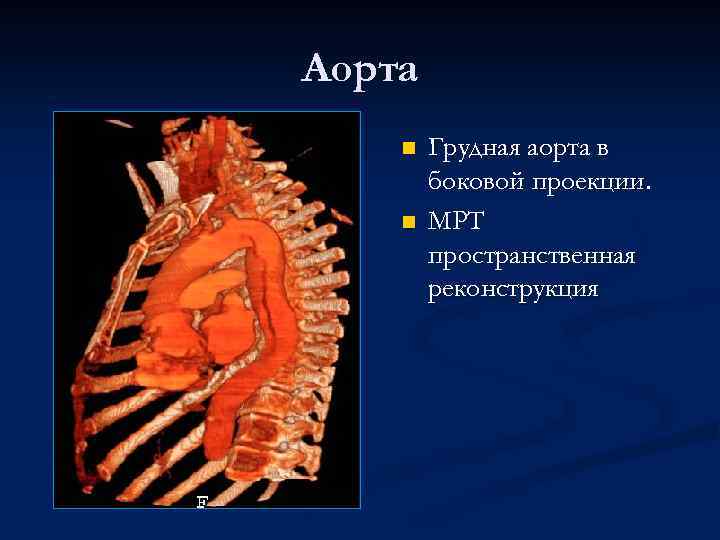 Аорта n n Грудная аорта в боковой проекции. МРТ пространственная реконструкция 