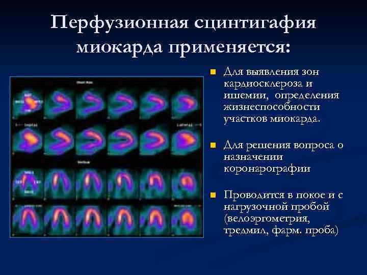 Перфузионная сцинтигафия миокарда применяется: n Для выявления зон кардиосклероза и ишемии, определения жизнеспособности участков