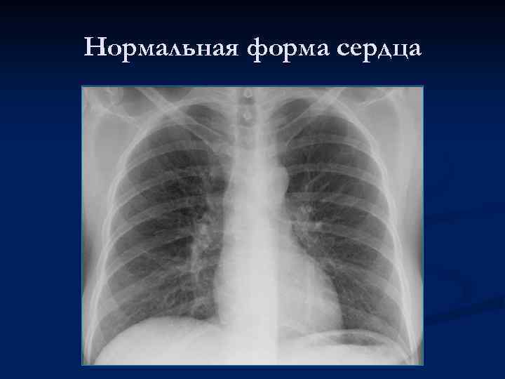 Нормальная форма сердца 