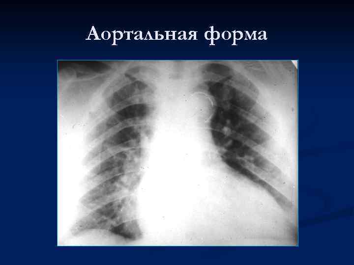 Аортальная форма 