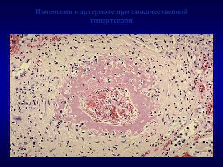 Изменения в артериоле при злокачественной гипертензии 