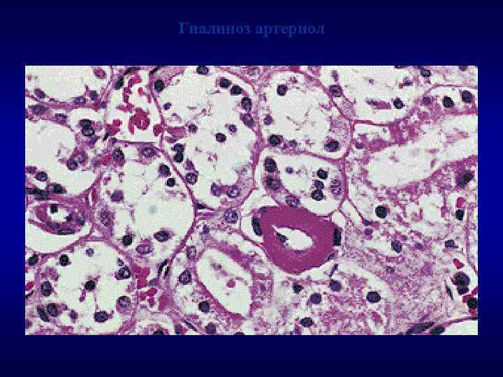 Гиалиноз артериол 