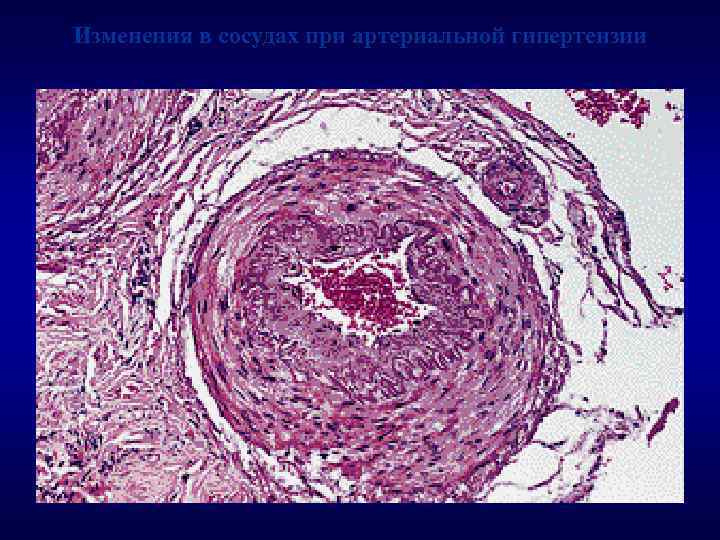 Изменения в сосудах при артериальной гипертензии 