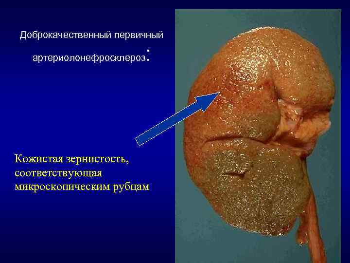 Доброкачественный первичный артериолонефросклероз : Кожистая зернистость, соответствующая микроскопическим рубцам 