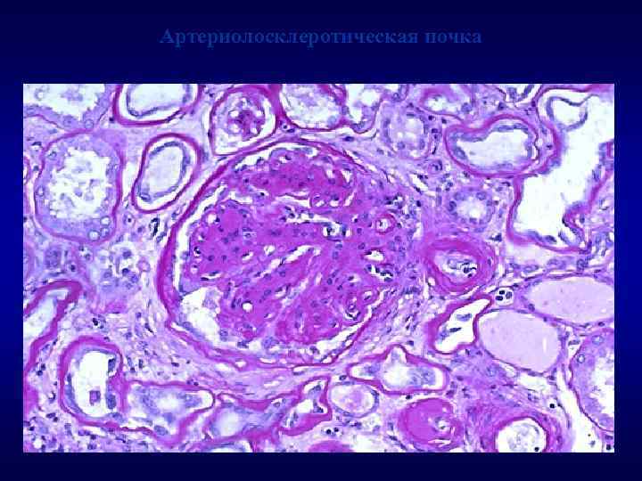 Артериолосклеротическая почка 