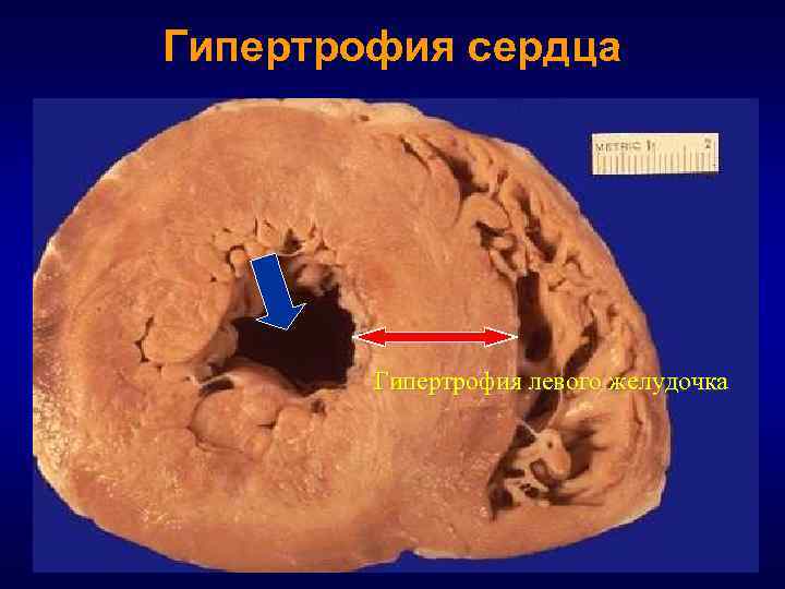 Гипертрофия сердца Гипертрофия левого желудочка 