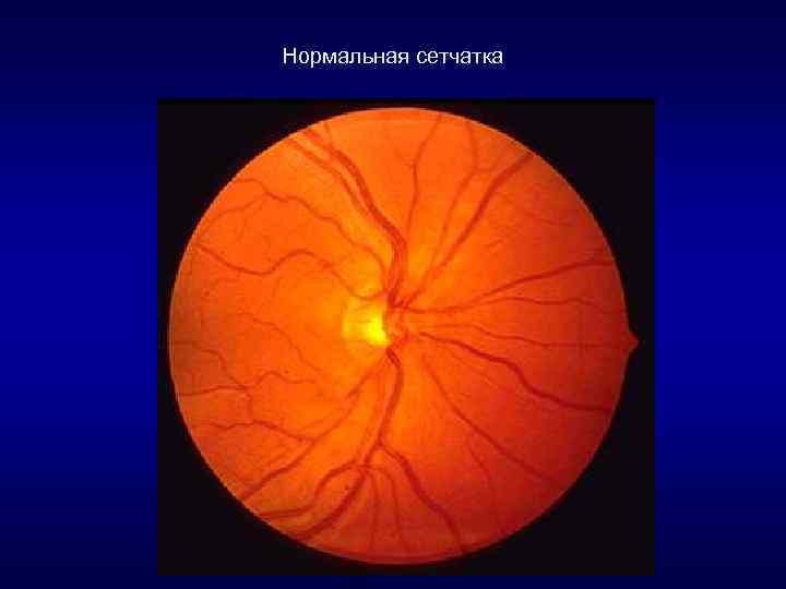 Нормальная сетчатка 