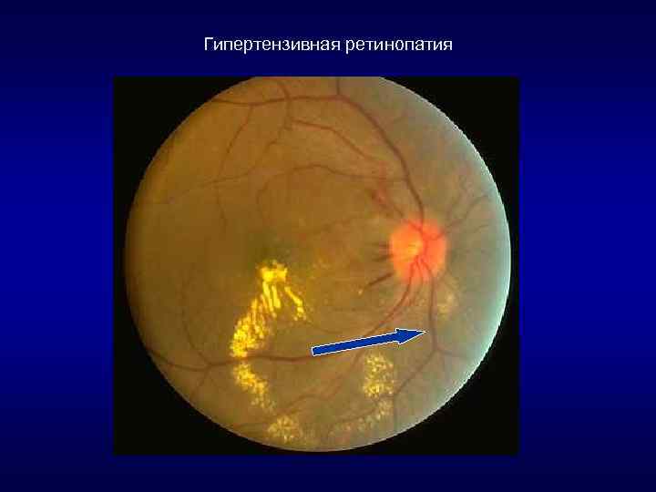 Гипертензивная ретинопатия 