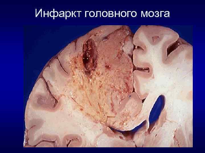 Инфаркт головного мозга 