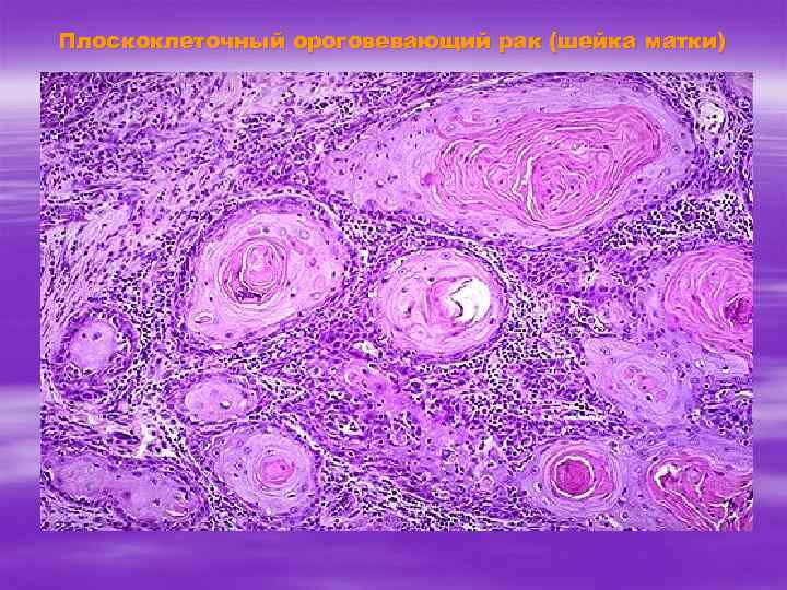 Плоскоклеточный ороговевающий рак (шейка матки) 