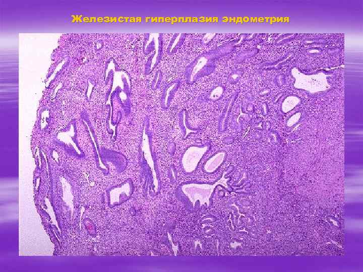 Железистая гиперплазия эндометрия 