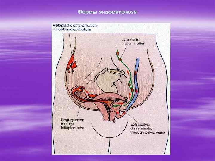 Формы эндометриоза 