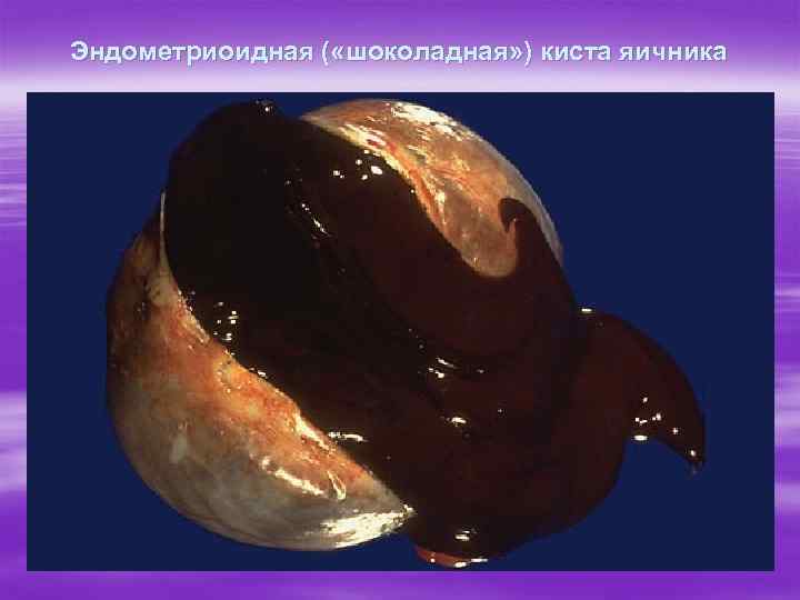 Эндометриоидная ( «шоколадная» ) киста яичника 