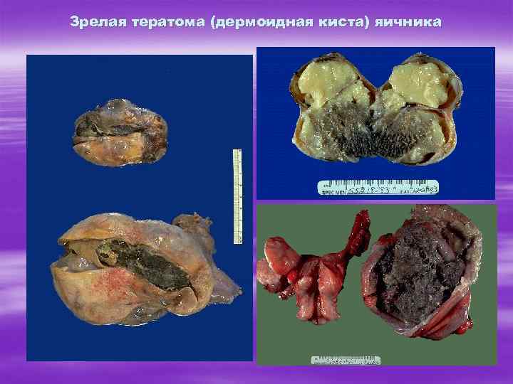 Зрелая тератома (дермоидная киста) яичника 