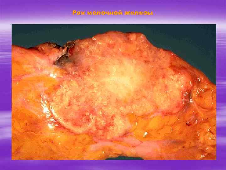 Рак молочной железы 